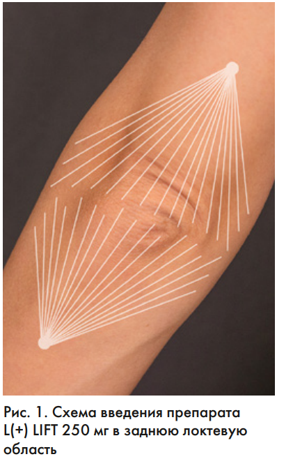 Схема введения препарата L(+) LIFT® 250 мг в заднюю локтевую область