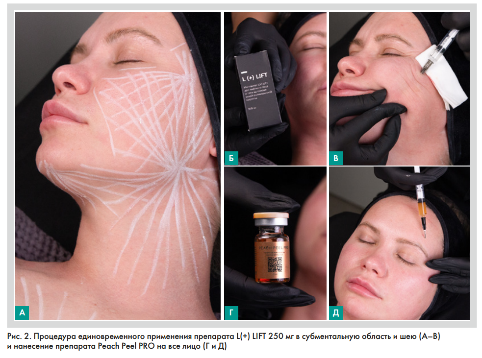 Процедура единовременного применения препарата L(+) LIFT® 250 мг в субментальную область и шею (А-В) и нанесение препарата Персиковый пилинг PRO (Peach Peel PRO) на все лицо (Г и Д)