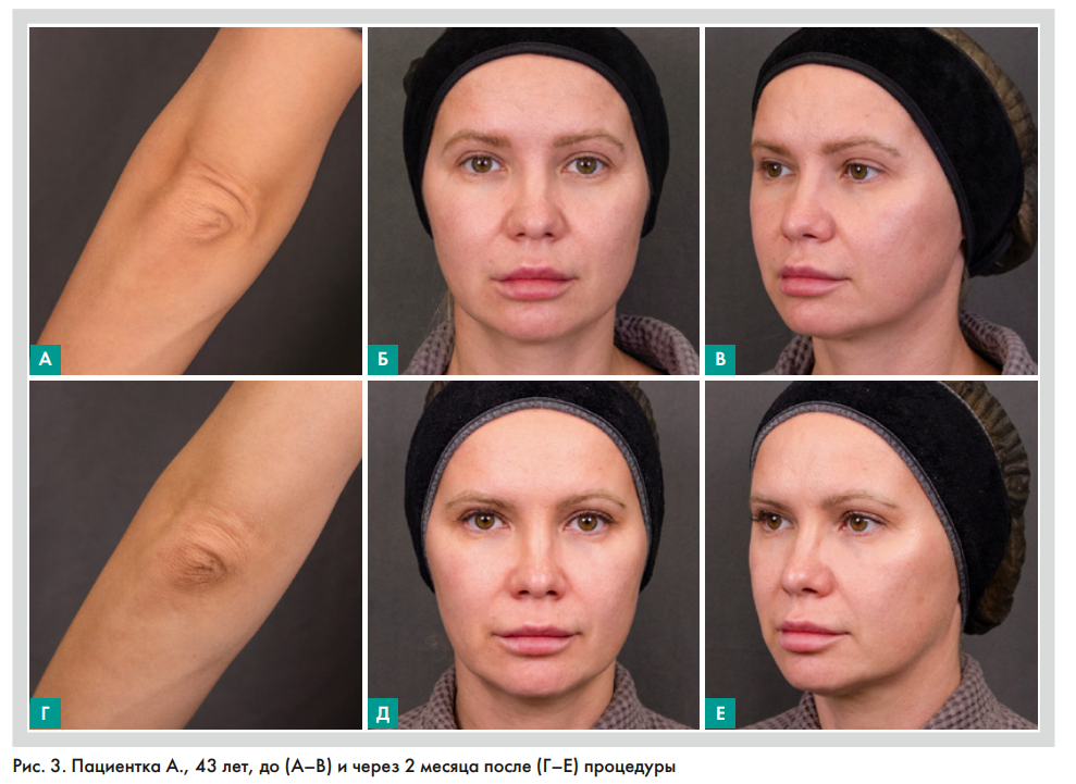 Пациентка А., 43 лет, до (А–В) и через 2 месяца после (Г–Е) процедуры
