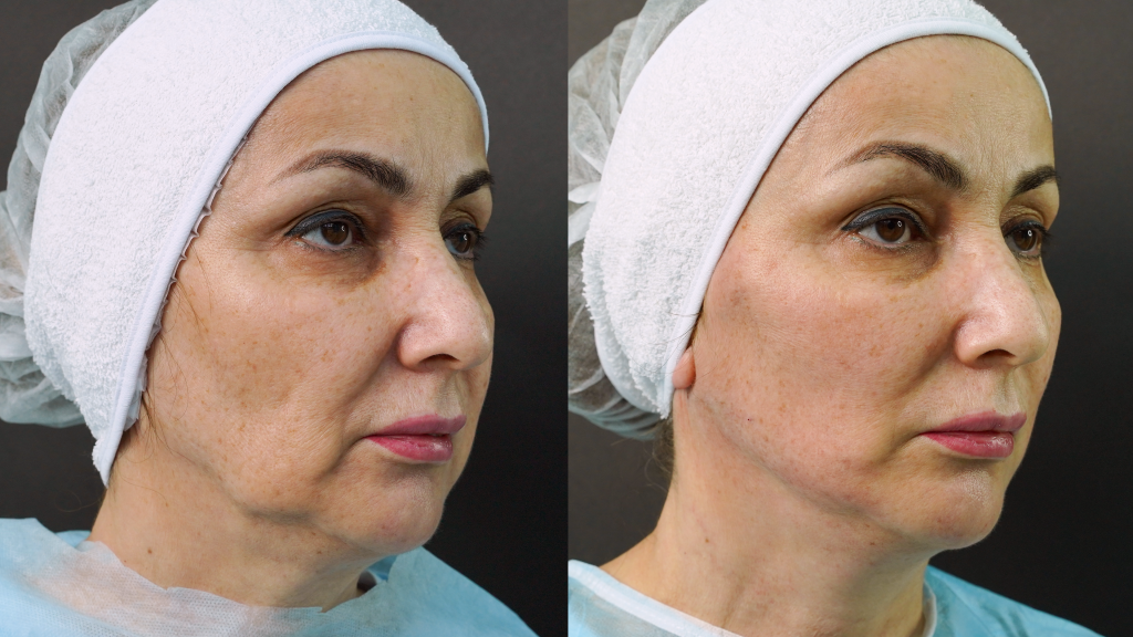 Оникс Лифт ПЛА (ONYX LIFT PLLA)