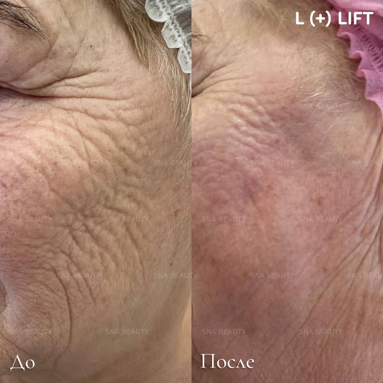 До / После L(+) Lift