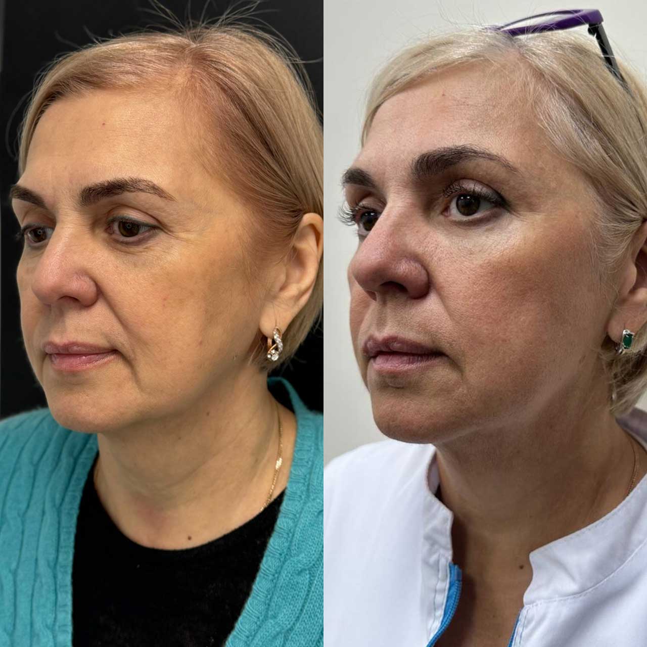 До / После L(+) Lift