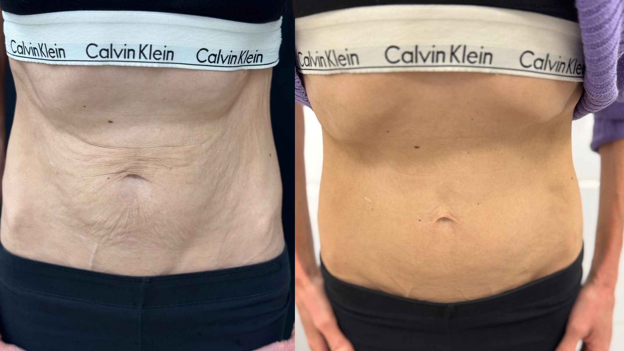 До / После L(+) Lift®