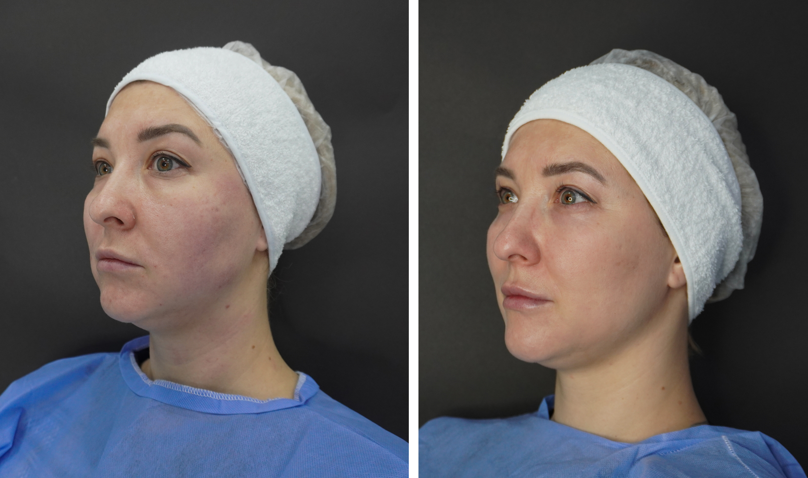 До / После L(+) Lift®