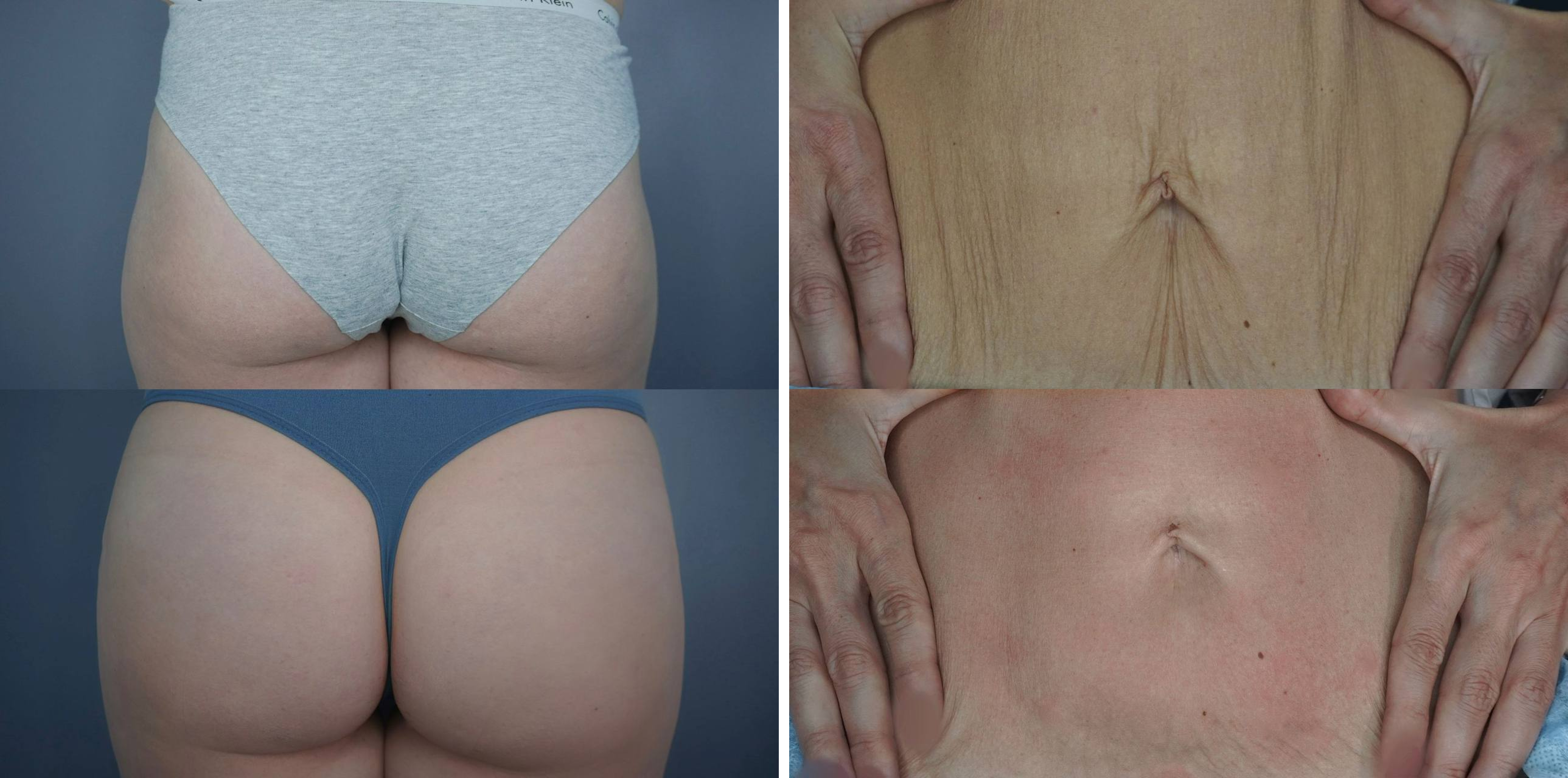 До / После L(+) Lift®