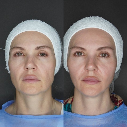 До / После L(+) Lift®