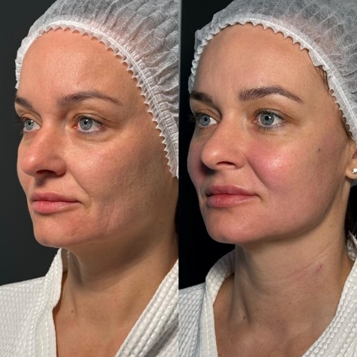 До / После L(+) Lift®