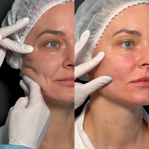 До / После L(+) Lift®